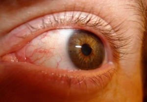 Последствия неправильно оказанной первой помощи при травмах глаз