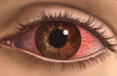 Ожоги глаз
