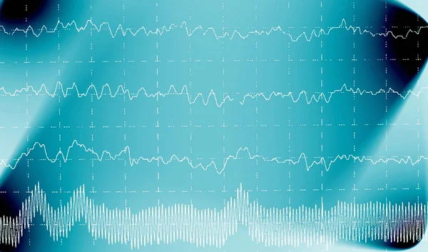 Мозг волны на электроэнцефалограмма ЭЭГ эпилепсии — стоковое фото